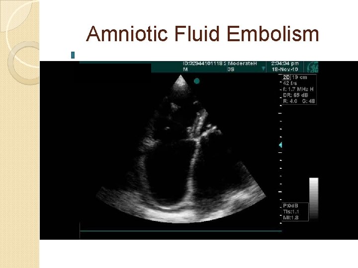 Amniotic Fluid Embolism 