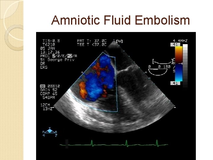 Amniotic Fluid Embolism 