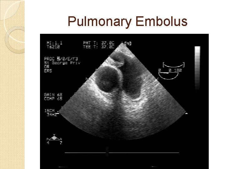 Pulmonary Embolus 