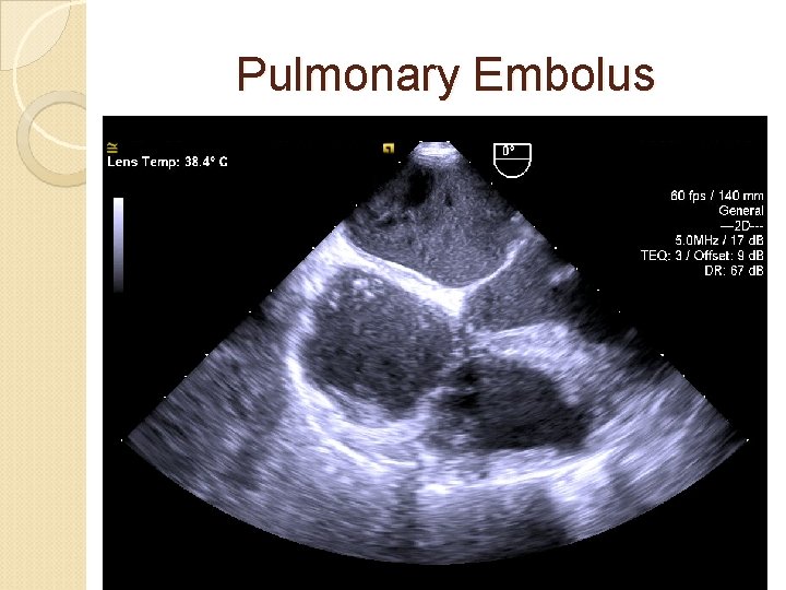Pulmonary Embolus 