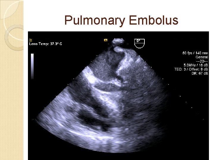 Pulmonary Embolus 