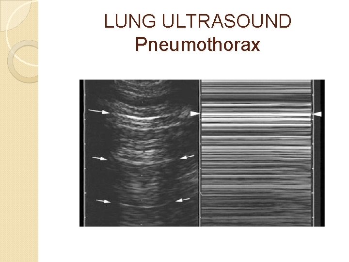 LUNG ULTRASOUND Pneumothorax 
