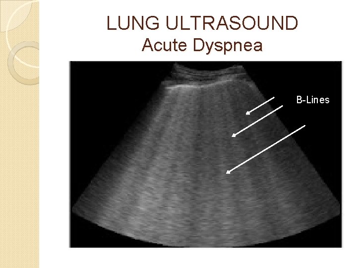 LUNG ULTRASOUND Acute Dyspnea B-Lines 