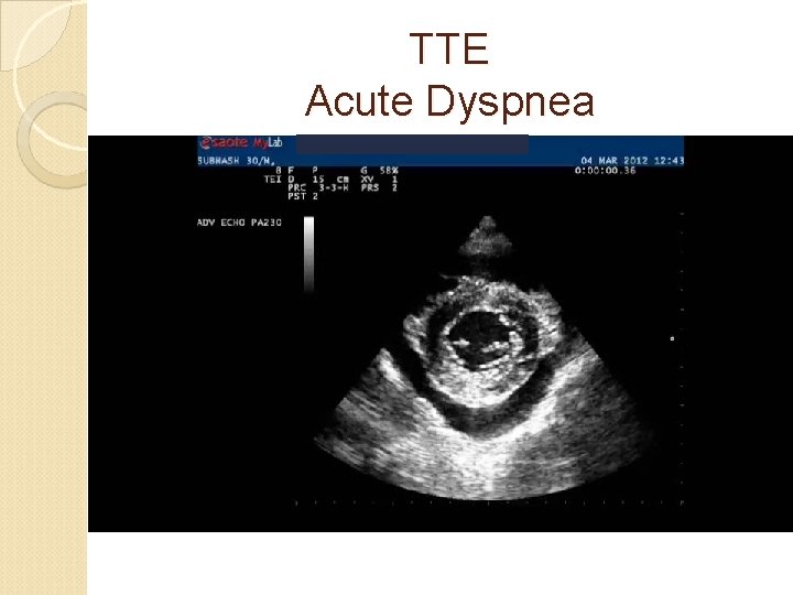 TTE Acute Dyspnea 