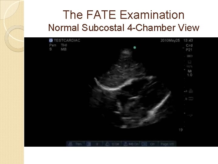 The FATE Examination Normal Subcostal 4 -Chamber View 