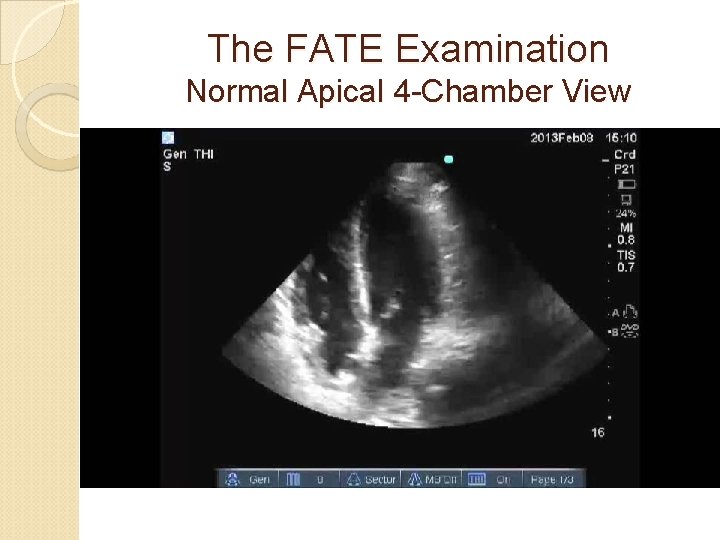 The FATE Examination Normal Apical 4 -Chamber View 