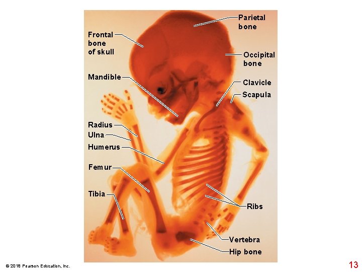 Frontal bone of skull Mandible Parietal bone Occipital bone Clavicle Scapula Radius Ulna Humerus