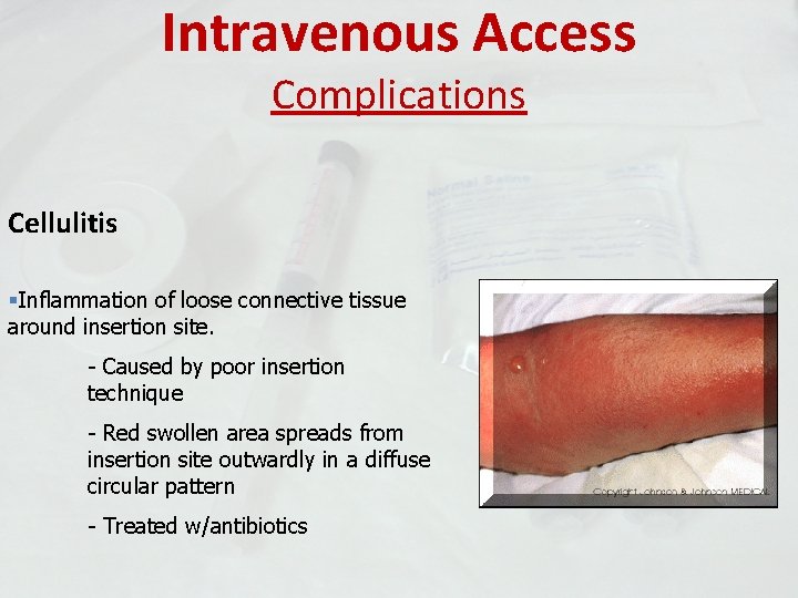 Intravenous Access Complications Cellulitis §Inflammation of loose connective tissue around insertion site. - Caused