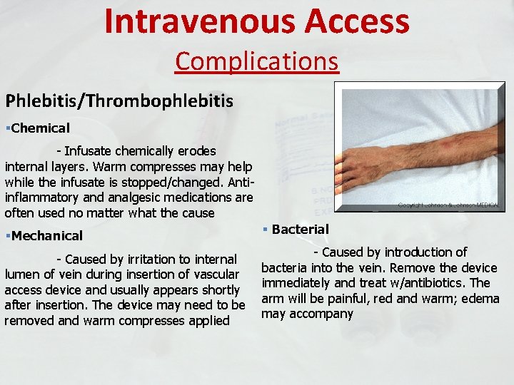Intravenous Access Complications Phlebitis/Thrombophlebitis §Chemical - Infusate chemically erodes internal layers. Warm compresses may