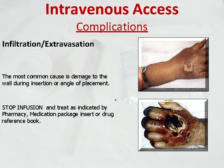 Intravenous Access Complications Infiltration/Extravasation The most common cause is damage to the wall during