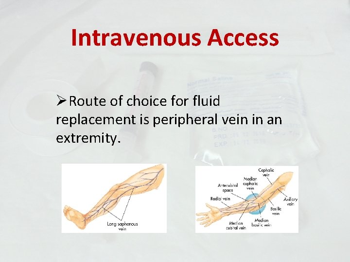 Intravenous Access ØRoute of choice for fluid replacement is peripheral vein in an extremity.