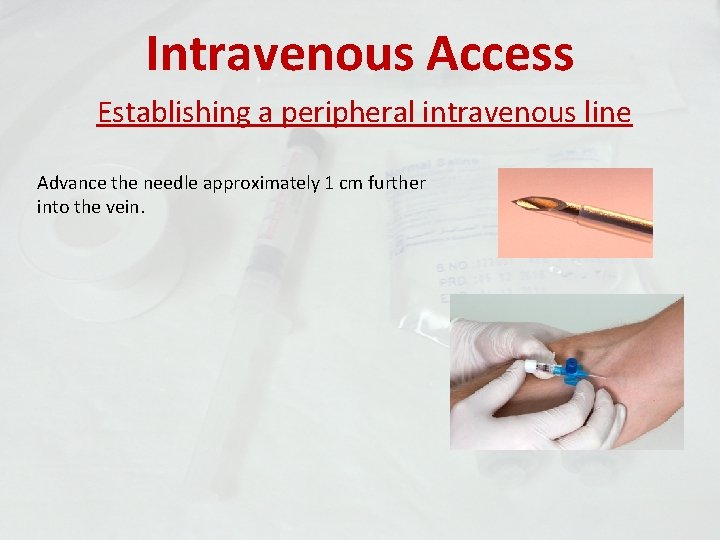 Intravenous Access Establishing a peripheral intravenous line Advance the needle approximately 1 cm further