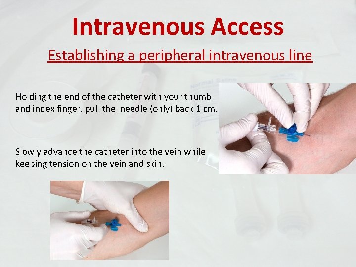 Intravenous Access Establishing a peripheral intravenous line Holding the end of the catheter with