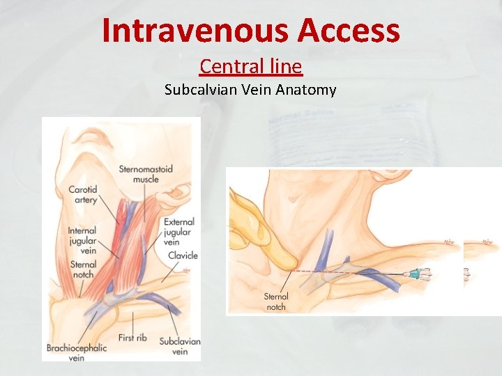 Intravenous Access Central line Subcalvian Vein Anatomy 