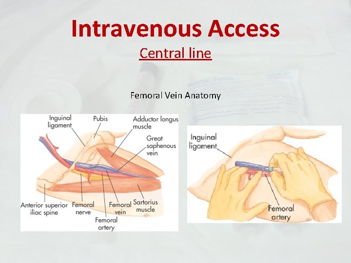 Intravenous Access Central line Femoral Vein Anatomy 