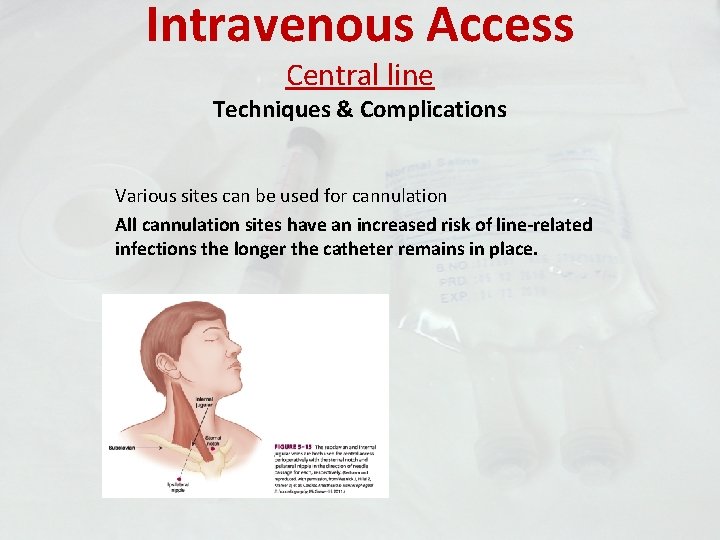 Intravenous Access Central line Techniques & Complications Various sites can be used for cannulation