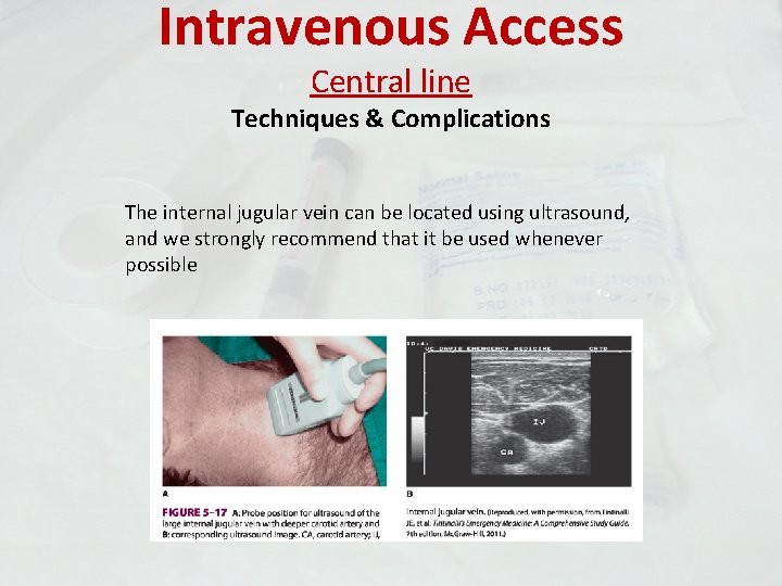 Intravenous Access Central line Techniques & Complications The internal jugular vein can be located