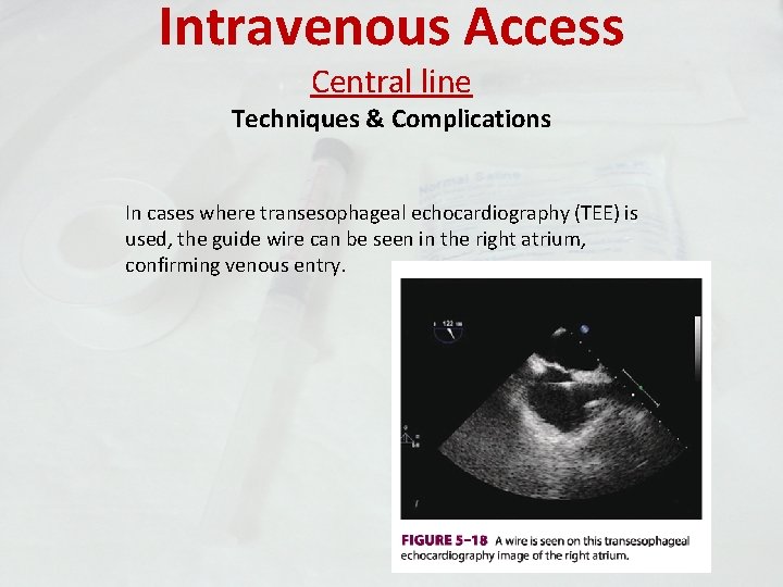 Intravenous Access Central line Techniques & Complications In cases where transesophageal echocardiography (TEE) is