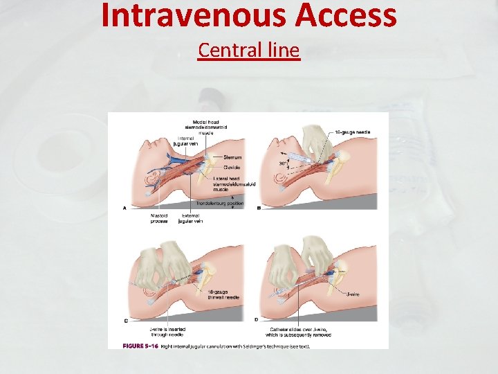 Intravenous Access Central line 