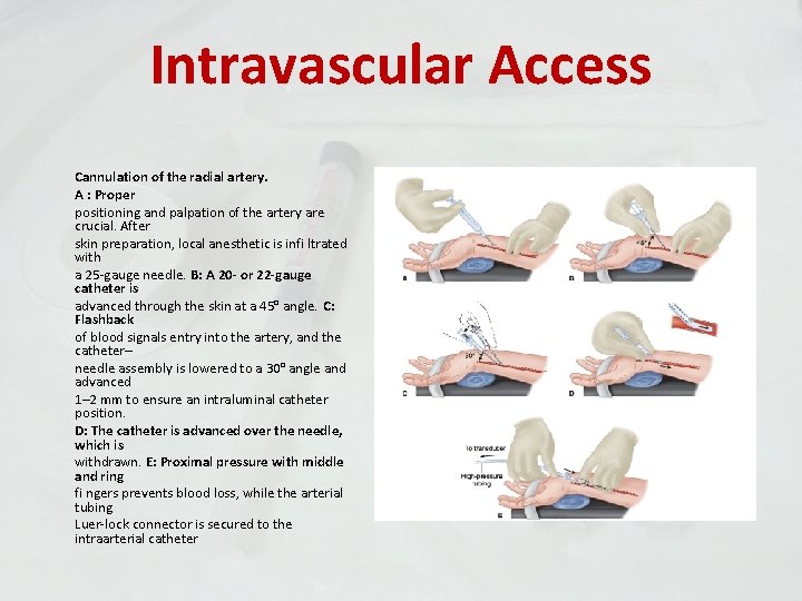 Intravascular Access Cannulation of the radial artery. A : Proper positioning and palpation of
