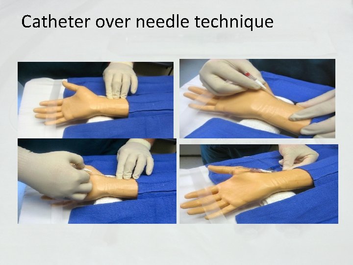 Catheter over needle technique 