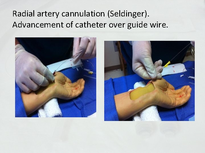 Radial artery cannulation (Seldinger). Advancement of catheter over guide wire. 