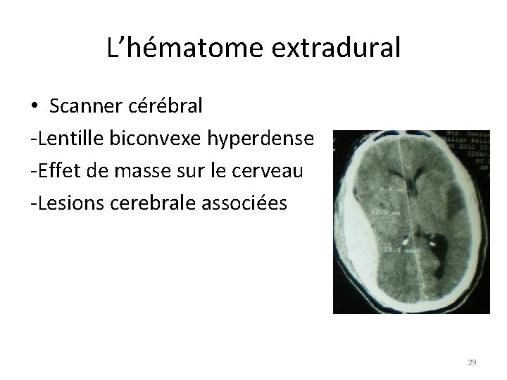 L’hématome extradural • Scanner cérébral -Lentille biconvexe hyperdense -Effet de masse sur le cerveau