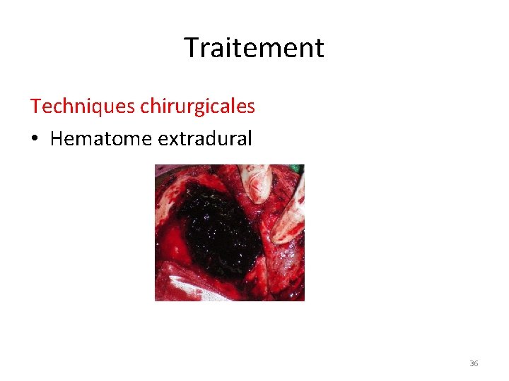 Traitement Techniques chirurgicales • Hematome extradural 36 