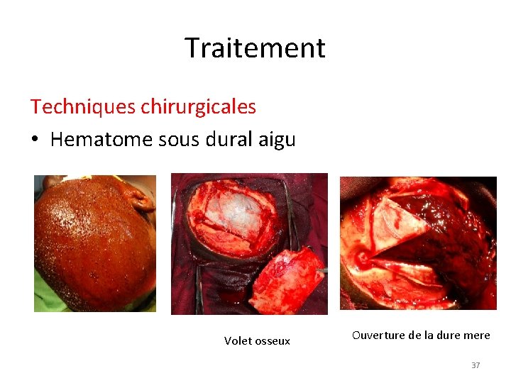 Traitement Techniques chirurgicales • Hematome sous dural aigu Volet osseux Ouverture de la dure