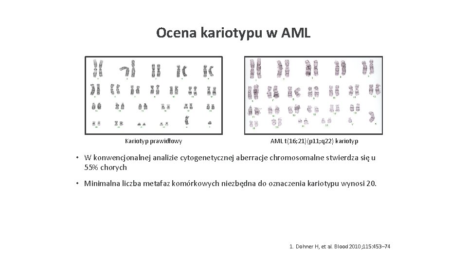 Ocena kariotypu w AML Kariotyp prawidłowy AML t(16; 21)(p 11; q 22) kariotyp •