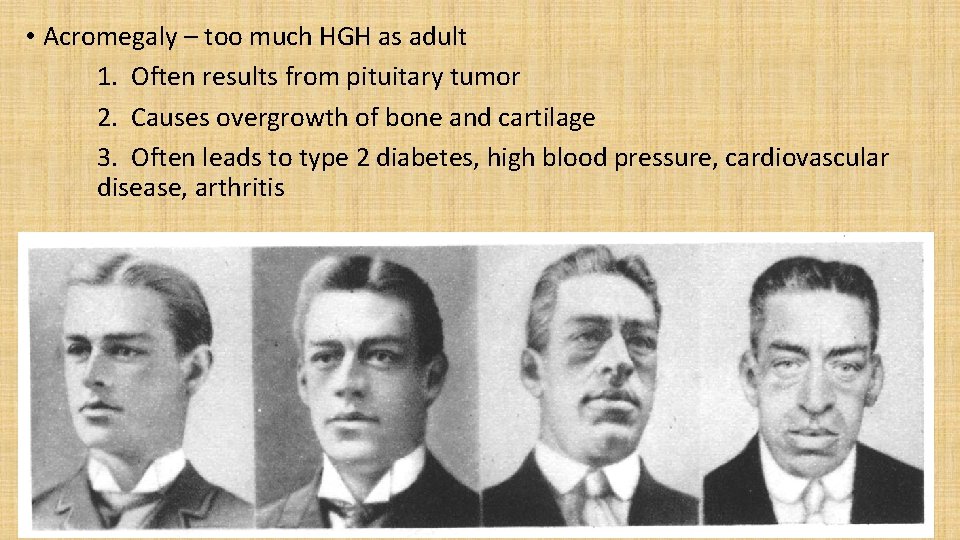  • Acromegaly – too much HGH as adult 1. Often results from pituitary