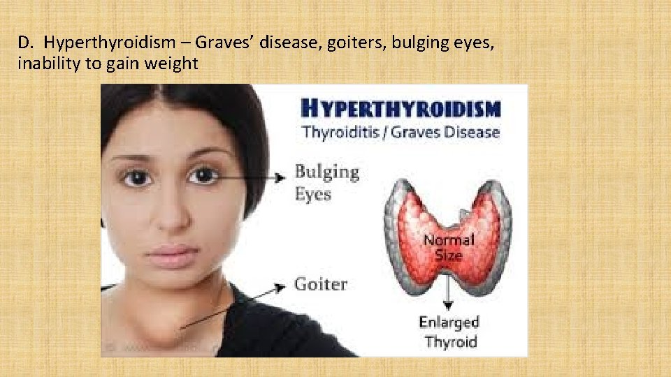 D. Hyperthyroidism – Graves’ disease, goiters, bulging eyes, inability to gain weight 