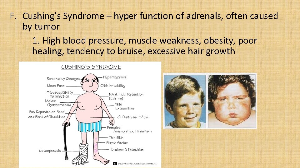 F. Cushing’s Syndrome – hyper function of adrenals, often caused by tumor 1. High