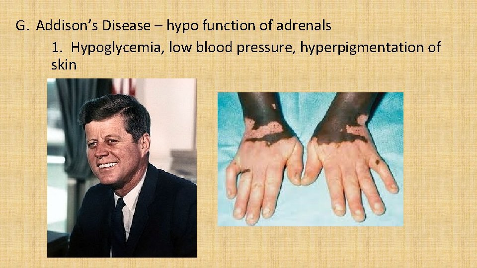G. Addison’s Disease – hypo function of adrenals 1. Hypoglycemia, low blood pressure, hyperpigmentation