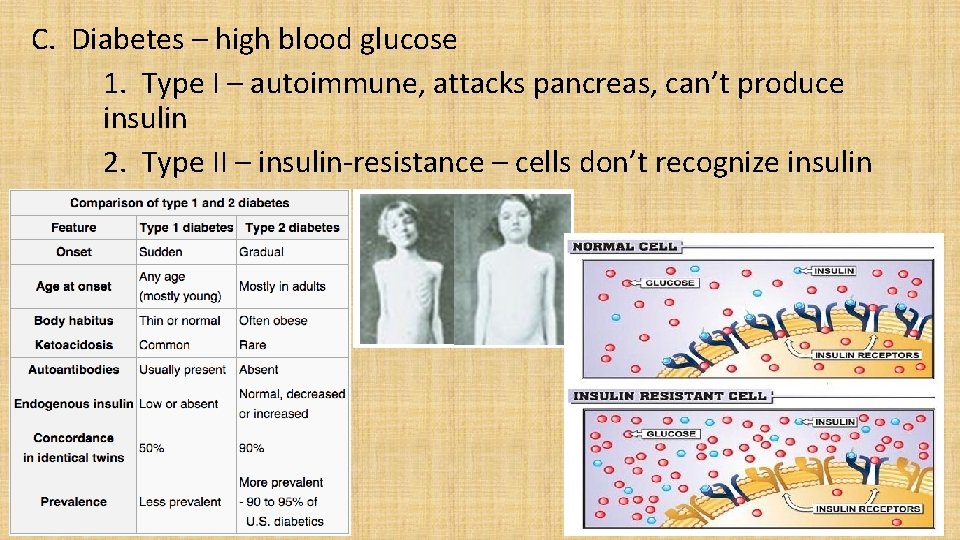 C. Diabetes – high blood glucose 1. Type I – autoimmune, attacks pancreas, can’t