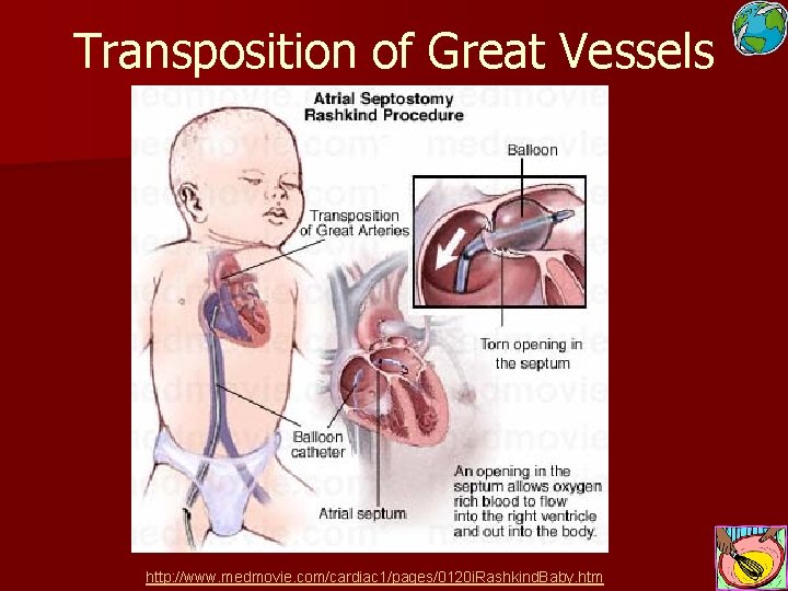 Transposition of Great Vessels http: //www. medmovie. com/cardiac 1/pages/0120 i. Rashkind. Baby. htm 