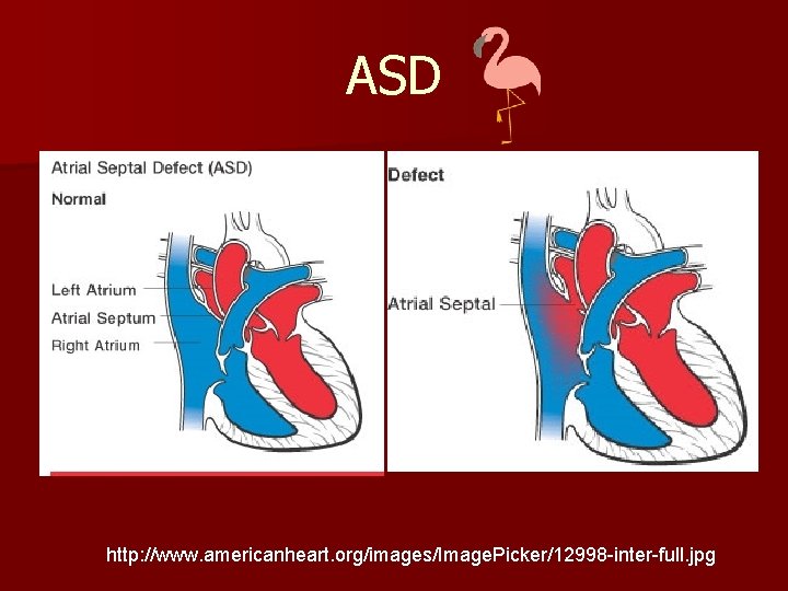 ASD http: //www. americanheart. org/images/Image. Picker/12998 -inter-full. jpg 