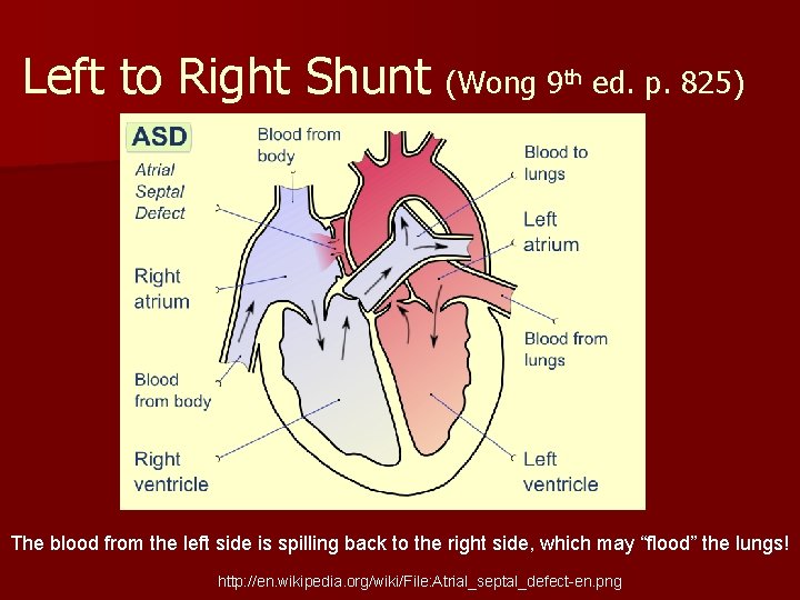 Left to Right Shunt (Wong 9 th ed. p. 825) The blood from the