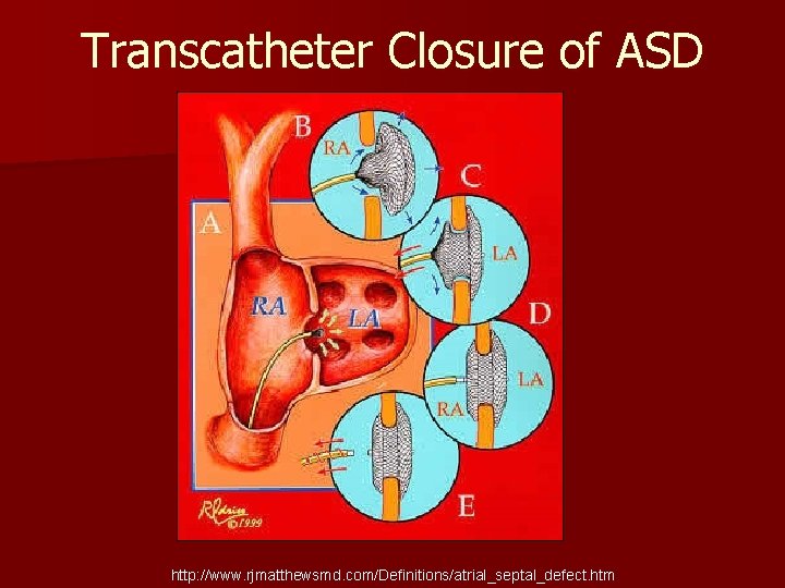 Transcatheter Closure of ASD http: //www. rjmatthewsmd. com/Definitions/atrial_septal_defect. htm 