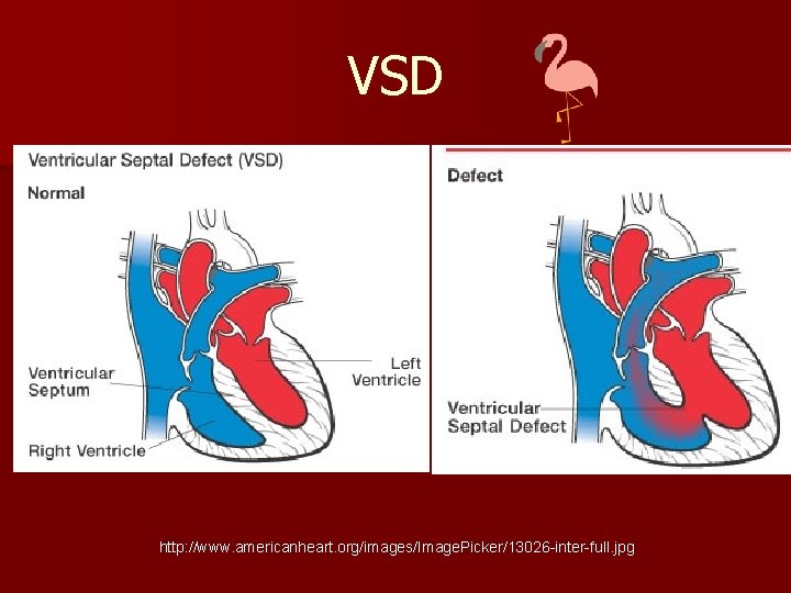 VSD http: //www. americanheart. org/images/Image. Picker/13026 -inter-full. jpg 