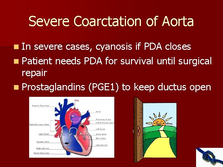 Severe Coarctation of Aorta n In severe cases, cyanosis if PDA closes n Patient