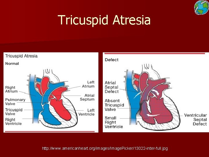 Tricuspid Atresia http: //www. americanheart. org/images/Image. Picker/13022 -inter-full. jpg 