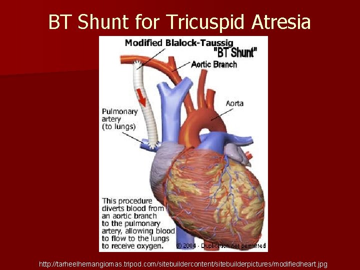 BT Shunt for Tricuspid Atresia http: //tarheelhemangiomas. tripod. com/sitebuildercontent/sitebuilderpictures/modifiedheart. jpg 