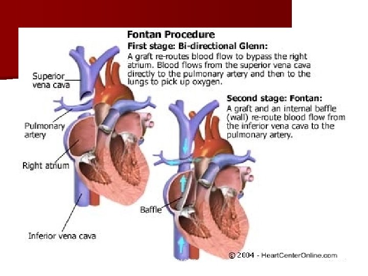 http: //www. severinbrenny. com/fontan_operation. html 