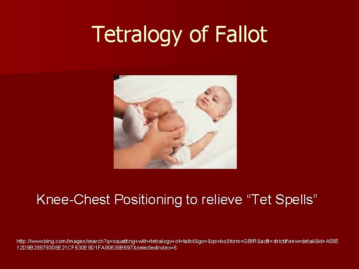 Tetralogy of Fallot Knee-Chest Positioning to relieve “Tet Spells” http: //www. bing. com/images/search? q=squatting+with+tetralogy+of+fallot&go=&qs=bs&form=QBIR&adlt=strict#view=detail&id=A