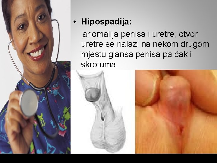  • Hipospadija: anomalija penisa i uretre, otvor uretre se nalazi na nekom drugom