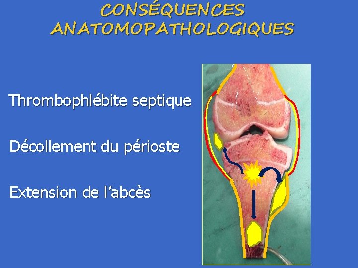 CONSÉQUENCES ANATOMOPATHOLOGIQUES Thrombophlébite septique Décollement du périoste Extension de l’abcès 