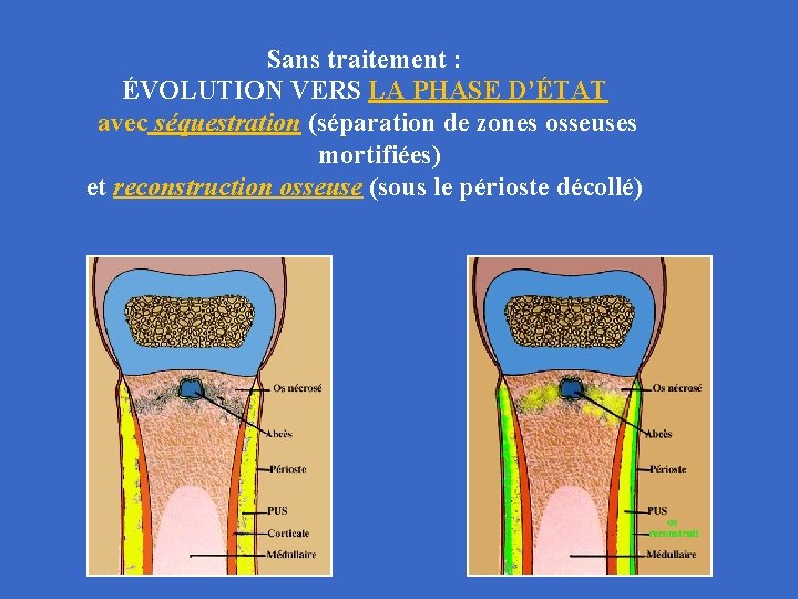 Sans traitement : ÉVOLUTION VERS LA PHASE D’ÉTAT avec séquestration (séparation de zones osseuses