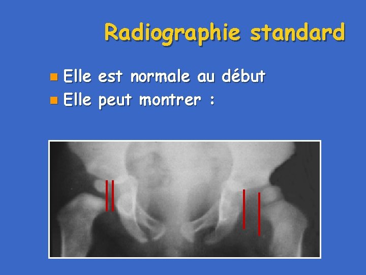 Radiographie standard Elle est normale au début n Elle peut montrer : n 