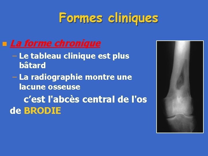 Formes cliniques n La forme chronique – Le tableau clinique est plus bâtard –